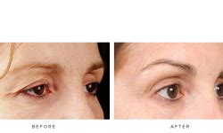 thermage eye    images infinity skin clinic