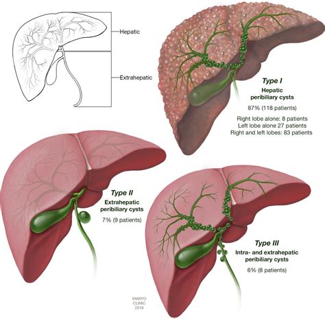 Peribiliary Cysts A Systematic Review And Proposal Of A Classification