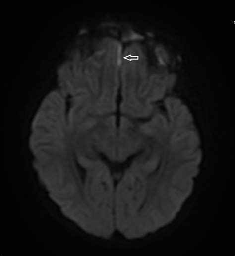 Septic Cavernous Sinus Thrombosis In A Paediatric Patient With Undiagnosed Thrombophilia Bmj