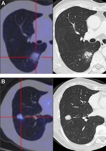 How Should Synchronous Multiple Primary Adenocarcinomas Of The Lung Be Resected The Annals Of