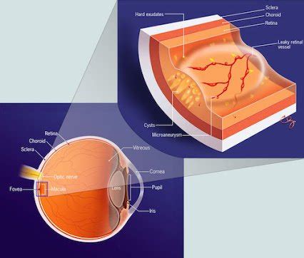 Nuovo laser 2RT per retinopatia diabetica - Studio Oculistico dottor Davì - Specializzato in ...