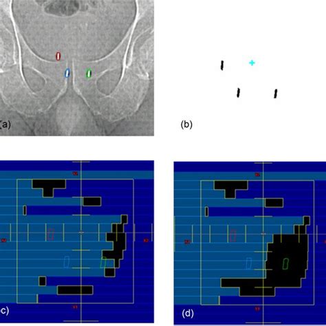 Fiducials Prepared For The Mvkv Treatment A Ct Scouts Showing Three