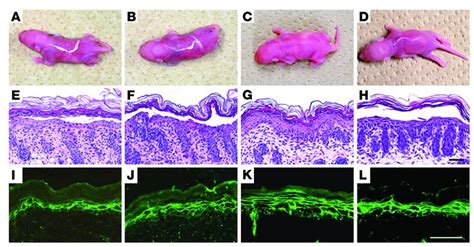 Staphylococcal Scalded Skin Syndrome Histology