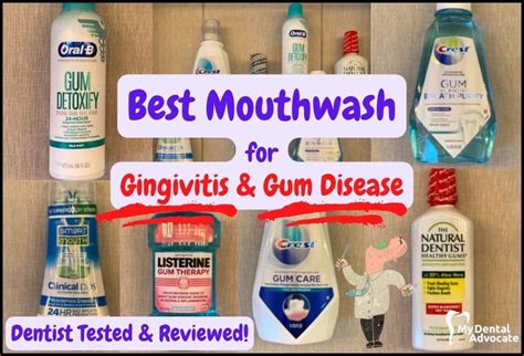 Gingivitis The Ultimate Guide 2024 MDA