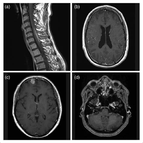 Zajicek Criteria A Clinical Presentation Suggestive Of Neurosarcoidosis