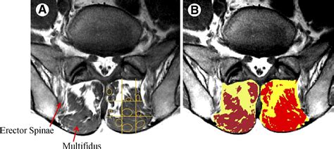 Multifidus Atrophy Is Localized And Bilateral In Active Persons With