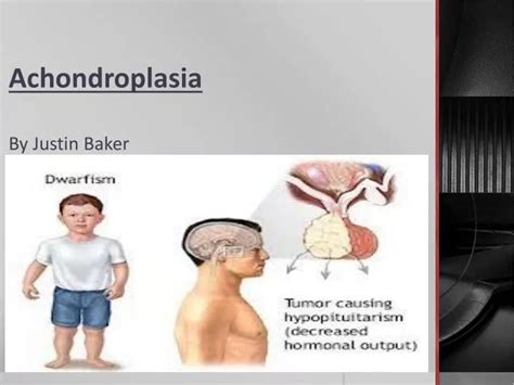 Ppt Achondroplasia By Justin Baker Powerpoint Presentation Free