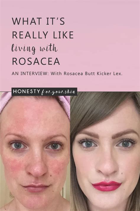 What Its Really Like Living With Rosacea Honesty For Your Skin