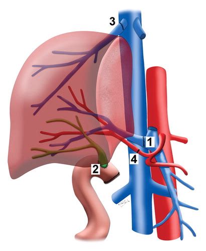 Postoperative Imaging In Liver Transplantation What Radiologists