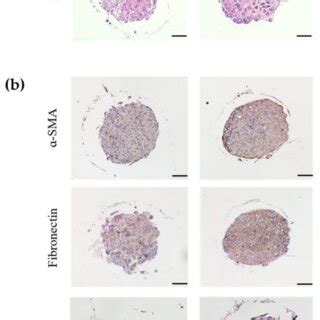 Establishment Of Mcts Model Using Patient Derived Hccs And Stromal