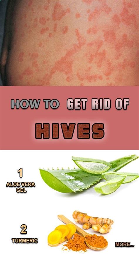 How To Get Rid Of Hives How To Get Rid Of Hives Get Rid Of Hives Hives