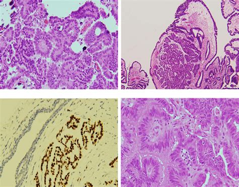 Serous Borderline Tumor With Microinvasion And Metastatic Low Grade