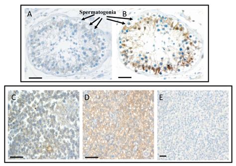 Immunohistochemistry Analysis Of Upa And Upar Expression In Human