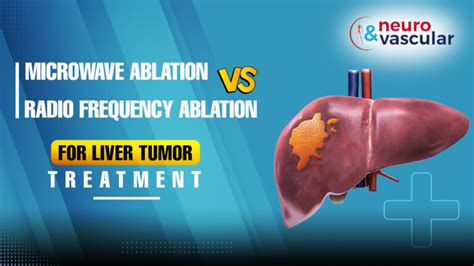 What Are The Interventional Therapies For Liver Cancer