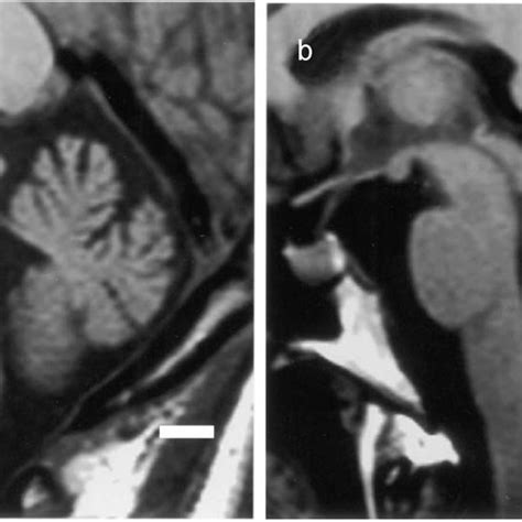 midsagittal mri   brainstem  cerebellum  case   case
