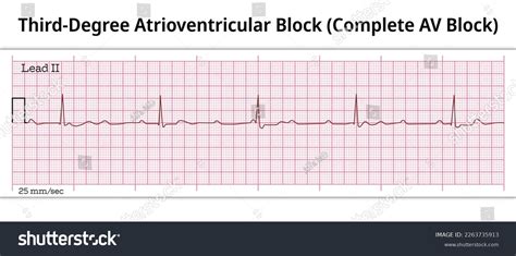 3rd Degree Av Block Rhythm Strip Clearance | www.jkuat.ac.ke