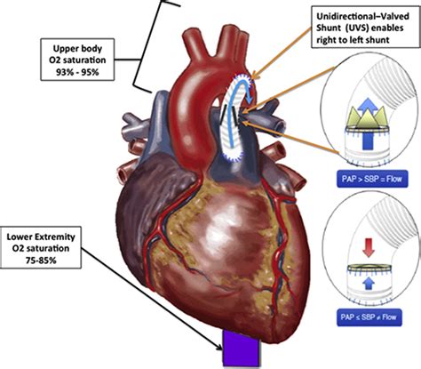 A Novel Shunt Approach Shows Promise For End Stage Pulmonary Arterial