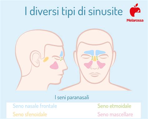 Sinusite Cos Cause Sintomi Diagnosi Cure E Prevenzione