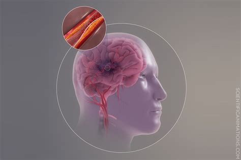 The Term Cerebral Thrombosis Is Defined As Giovani Has Townsend