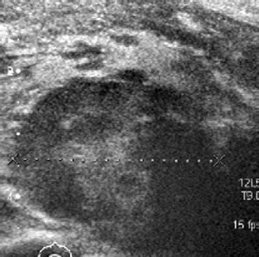 Ultrasonography Of Case With Medullary Thyroid Cancer Showing