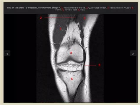 Presentation Pptx Radiological Anatomy Of The Knee Joint Ppt