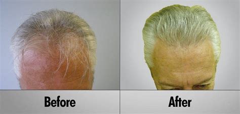 Hair Transplant Client Photo Gallery Sure Hair Transplants Toronto Ontario Canada