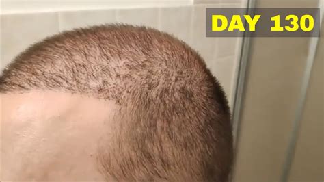 Hair Transplant Results Day 130 YouTube