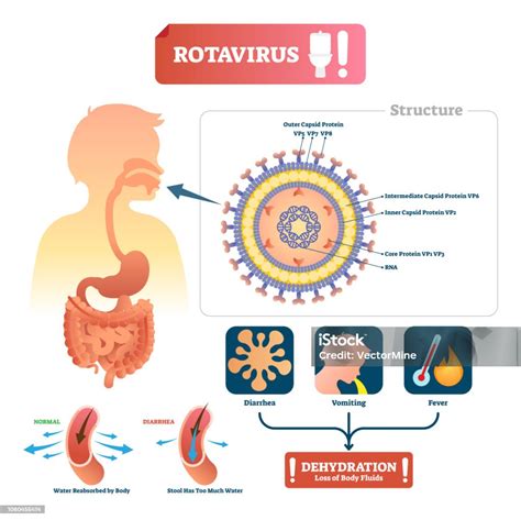 Ilustración De Ilustración De Vector De Rotavirus Etiquetado Enfermedad