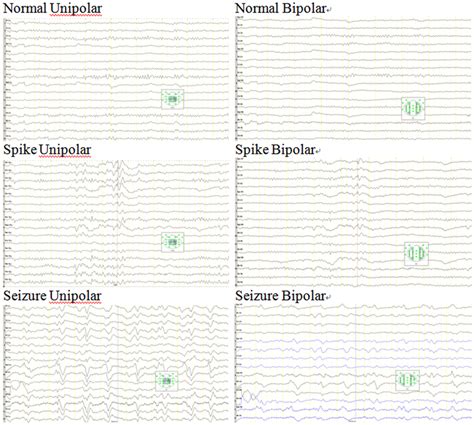 Exemplars Of EEG From The Three Conditions Normal Spike And Seizure