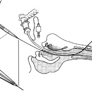 Tape De La R Alisation D Une Trach Otomie Percutan E Translaryng E Et