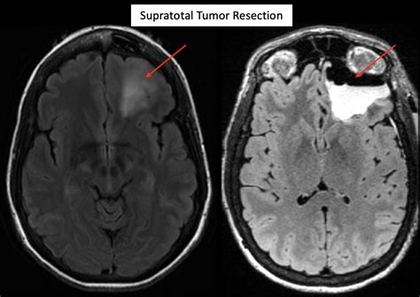 Maximizing Tumor Resection Improves Low Grade Glioma Patient Outcomes