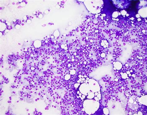 bone marrow aspirate smear