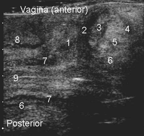 Ultrasonographic Anatomy Of Perineal Structures During Pregnancy And