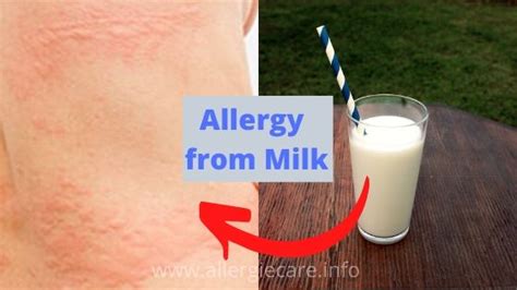 Allergy from milk symptom, to cure and more - Allergie Care