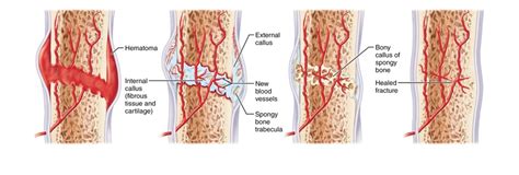 bone remodeling Diagram | Quizlet