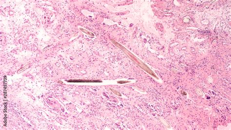 Pilonidal Disease With Hair Containing Cysts Sinuses Or Abscesses