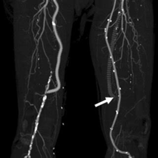 Postoperative computed tomography reveals patency of the bypass graft... | Download Scientific ...