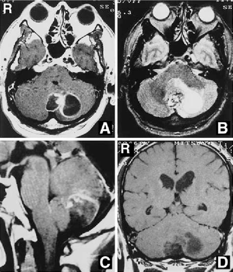 Figure 2 From Squamous Cell Carcinoma Arising In An Intracranial