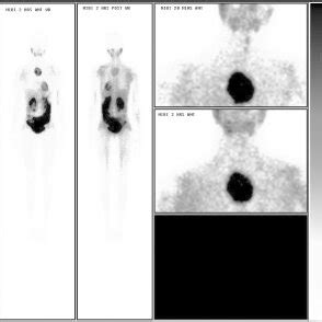 M Tc Pertechnetate Whole Body Scan Anterior And Posterior Views