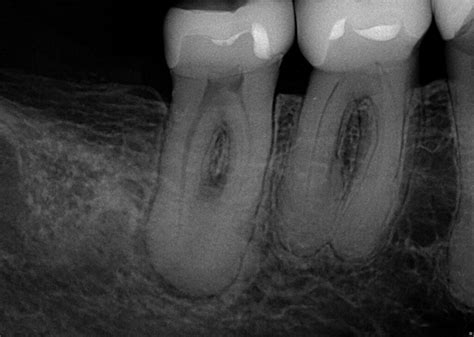 Minimally Invasive Endodontics With Laser Activated Irrigation