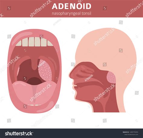 Nasal Throat Nasopharynx Diseases Adenoids Diagnosis стоковая