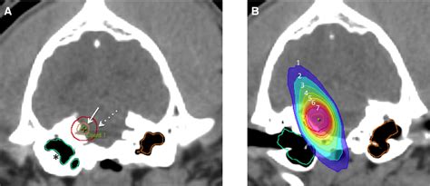 Treatment Of Mri‐diagnosed Trigeminal Peripheral Nerve Sheath Tumors By