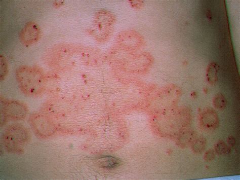 DERMATITIS HERPETIFORME Binipatia E Higienismo