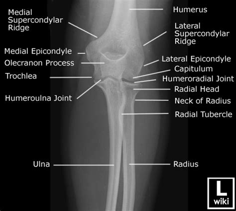 Radiographic Anatomy Of The Elbow Radiologypicscom