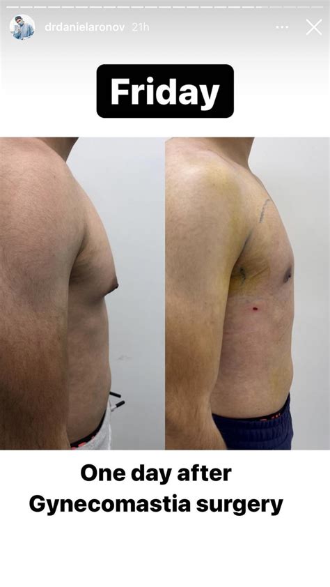 Before and after 1 day : r/gynecomastia