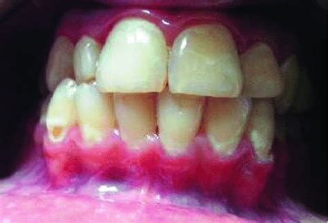 The initial appearance of buccal non-cavitary caries | Download Scientific Diagram