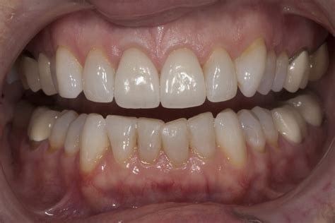 Before And After Gallery Envision Dental Dentist In Marietta Ga