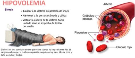 Hipovolemia Y Shock Hipovolémico Etapas Causas Síntomas