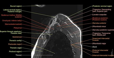 Brachial Plexus Mri