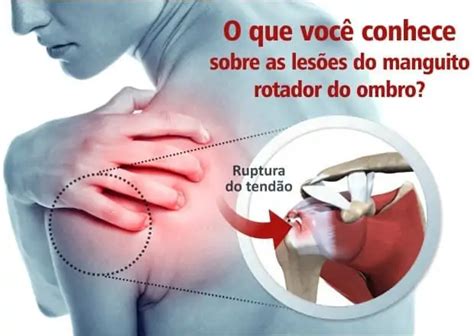 S Ndrome Do Impacto No Ombro Conceito Causas Sintomas E Tratamento